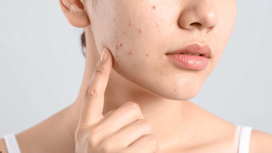 Akne och finnar i ansiktet efter microneedling, exempel på tillfällig hudreaktion efter behandling.